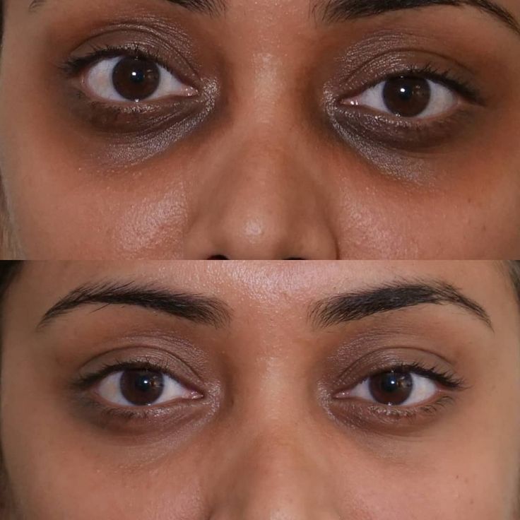 Anti-cernes hydratant pour les yeux